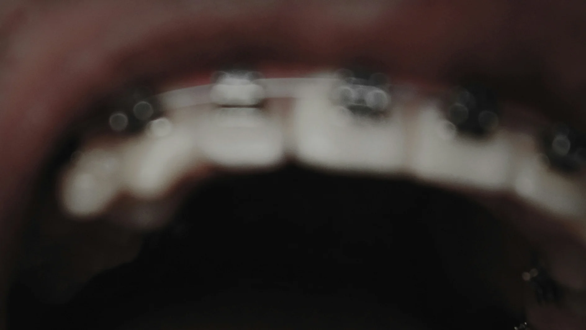 Oberkiefer mit Brackets und Bogen, Bild zum Thema feste Zahnspange in München-Schwabing